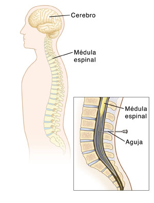 Ilustración de la médula espinal, el cerebro, y la inserción de la aguja utilizada para una punción lumbar.