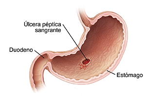 Corte transversal de estómago y duodeno. Se ve una llaga sangrante en el recubrimiento del estómago que es una úlcera péptica que sangra.