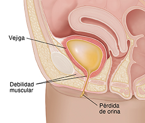 Primer plano de un corte transversal de la pelvis femenina con pérdida de orina debido a la incontinencia.