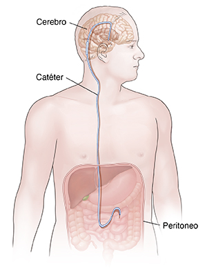 Vista frontal de la cabeza y el tórax de un hombre en la que puede verse la derivación ventriculoperitoneal saliendo del cerebro hacia la cavidad abdominal.