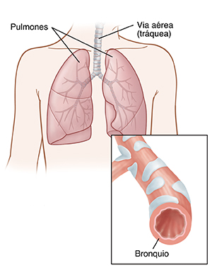 Vista frontal del pecho de un niño donde se observan los pulmones. El recuadro muestra un corte transversal de los bronquios.