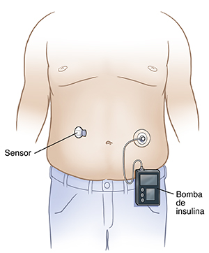 Vista frontal del torso de un hombre con el sensor del medidor de glucosa continuo en el abdomen, colocado cerca de un lado del ombligo. Receptor unido al sistema de administración de insulina en el otro lado del ombligo.