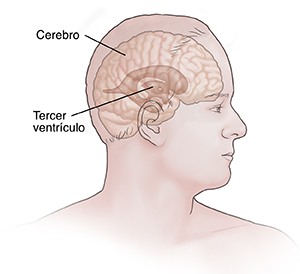 Vista lateral de la cabeza de un hombre donde se observan los ventrículos normales en el cerebro.