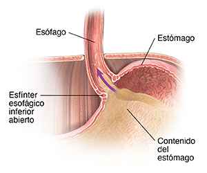 Primer plano de corte transversal de la parte superior del estómago, la parte inferior del esófago y el diafragma donde se observa el esfínter esofágico inferior abierto, lo que permite que el contenido del estómago suba por el esófago.