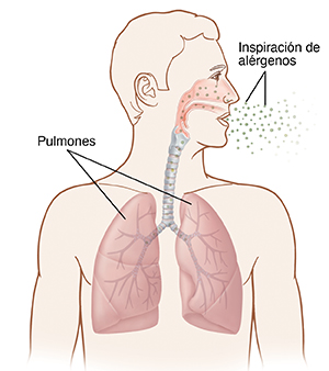 Vista frontal de la cabeza y el tórax de un hombre en la que pueden verse alérgenos entrando en los pulmones.