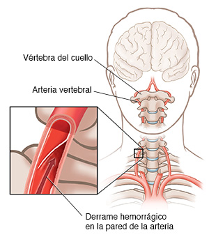 Vista frontal del contorno de un hombre donde se observan las arterias vertebrales y una imagen ampliada de la disección en una arteria vertebral.