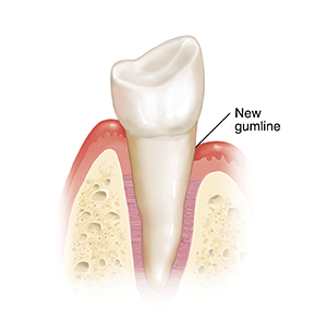 Side view of tooth in bone with gum lower on right side.